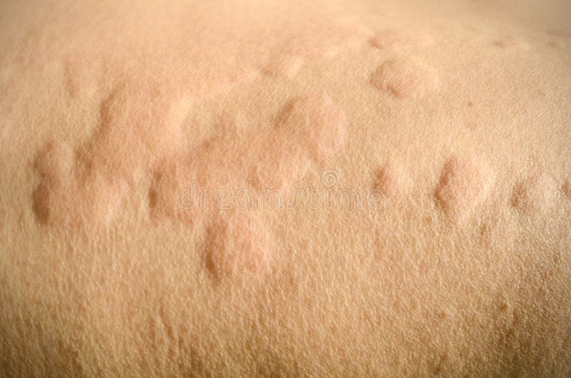 Skin Rash Urticaria Allergic Skin Reaction Stock Image Image Of