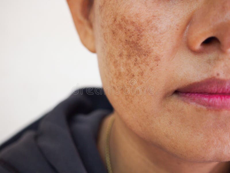 Skincare problemático e conceito de saúde. rugas melasma manchas escuras sarda pele seca face a mulher da meia-idade.