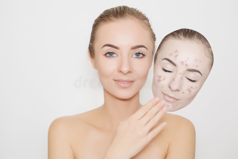 Sking mau ausente posto com espinhas, acne imagens de stock royalty free Sking mau ausente posto com espinhas, acne imagens de stock royalty free