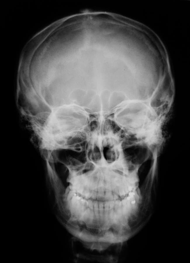 Skull x-ray image stock photo. Image of medical, roentgen - 12941892