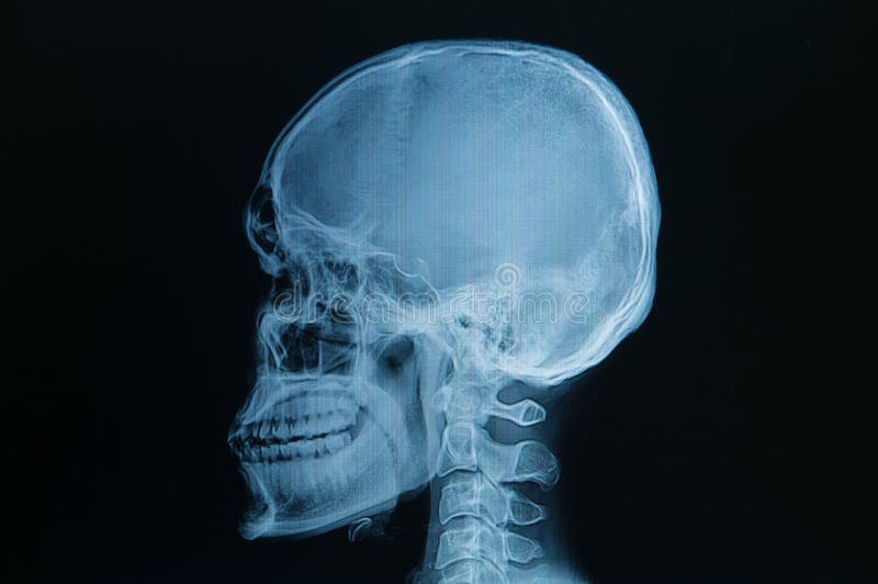 Skull X-Ray Изображения: просматривайте стоковые фотографии, векторные изображен