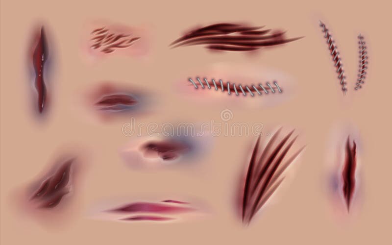 Sk?r rany i blizny Operacja ?ciegi i horror rany na sk?rze, r??nych urazach i st?uczeniach, Wektorowa cia?o rana i ilustracja wektor Sk?r rany i blizny Operacja ?ciegi i horror rany na sk?rze, r??nych urazach i st?uczeniach, Wektorowa cia?o rana i ilustracja wektor