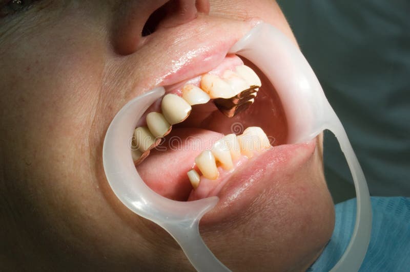 opleiding temperatuur Brawl Slechte tanden stock afbeelding. Image of bederf, lippen - 3299635