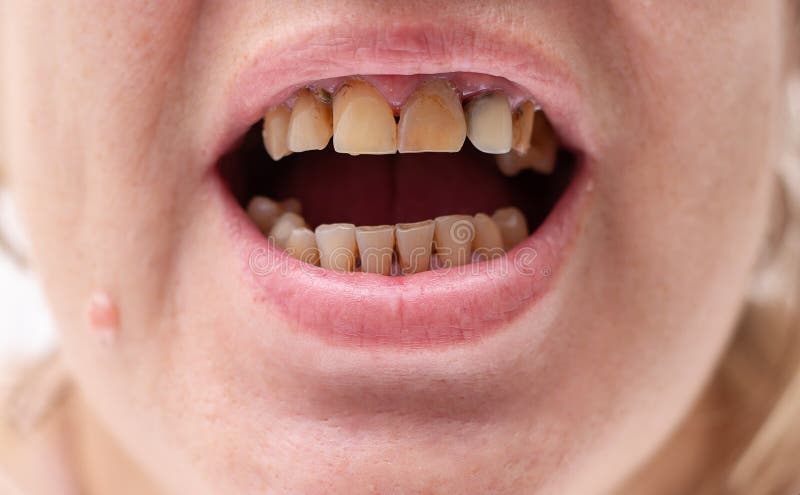 Moeras Fondsen Erfgenaam Slechte Tanden in Een Rookvrouw Stock Afbeelding - Image of persoon, tanden:  167381073