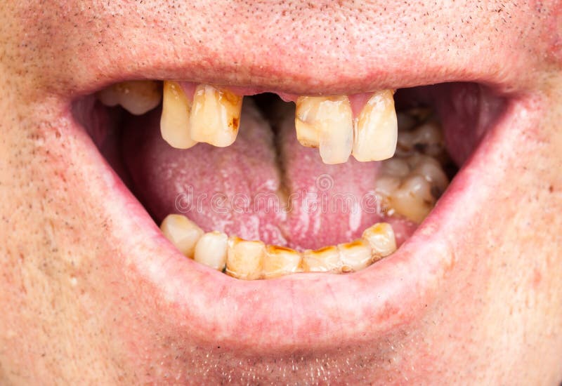 Middag eten Mening Aangepaste Slechte tanden, roker stock afbeelding. Image of roker - 81711899
