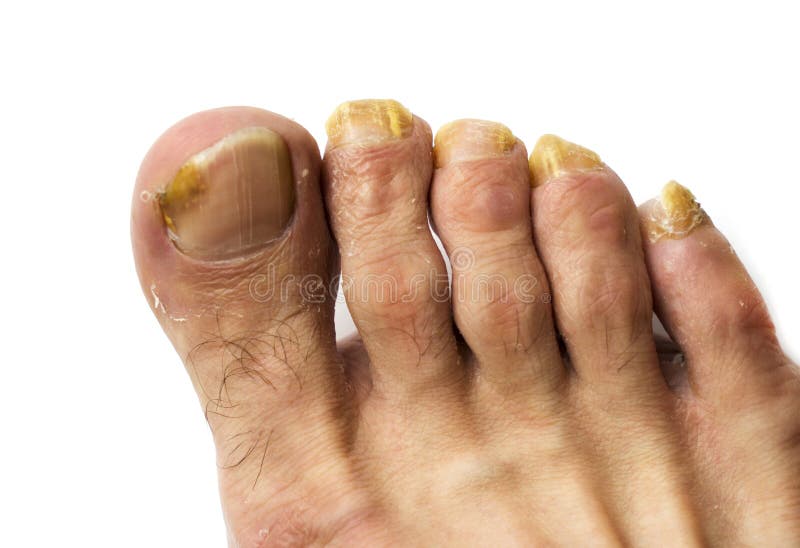 Fekete körmök láb cukorbetegség kezelésének. A körmök fekete cukorbetegség