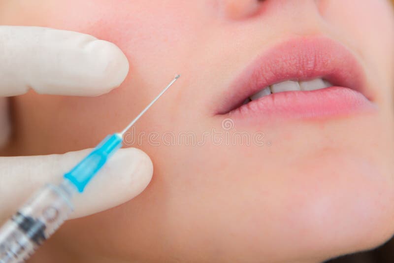 Sluit omhoog mening van een lippeninjectie stock foto Sluit omhoog mening van een lippeninjectie stock foto