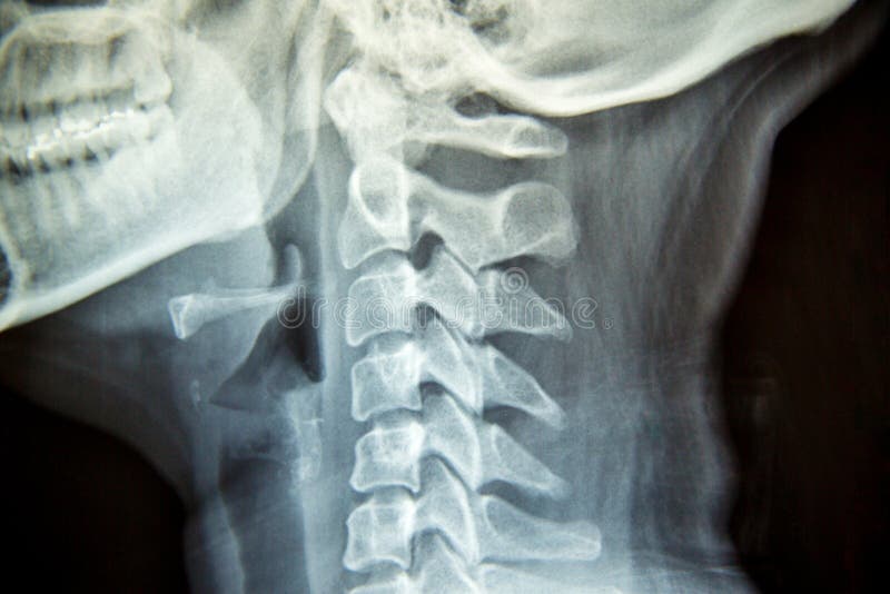 Sluit x-ray film tonen cervicale stekel of c-stekel, x-ray film van halsbeenderen stock fotografie Sluit x-ray film tonen cervicale stekel of c-stekel, x-ray film van halsbeenderen stock fotografie