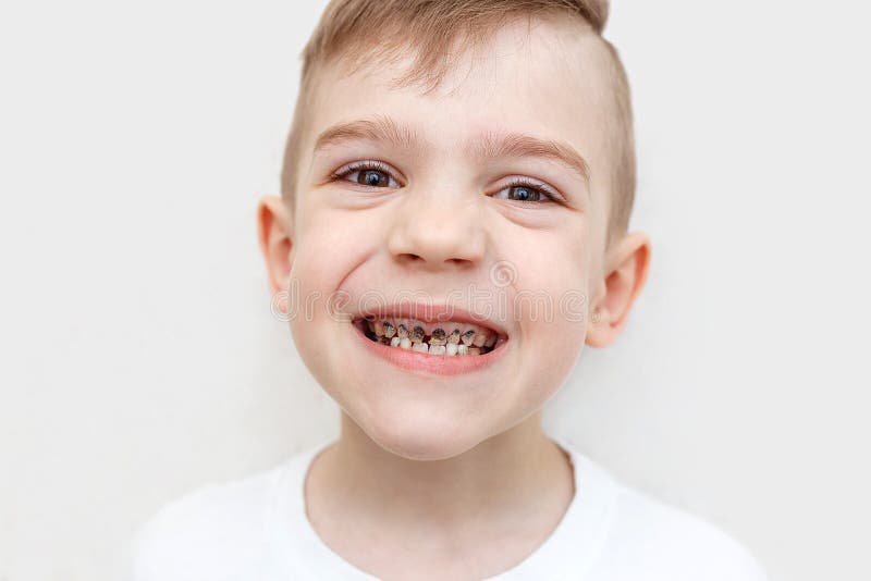 Slutet sk?t upp av t?nder f?r en pojke med karies H?lsov?rd, tand- hygien och barndombegrepp tand- problem royaltyfria bilder Slutet sk?t upp av t?nder f?r en pojke med karies H?lsov?rd, tand- hygien och barndombegrepp tand- problem royaltyfria bilder