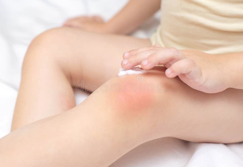 Chafing Skin Stock Photos - Free & Royalty-Free Stock Photos from