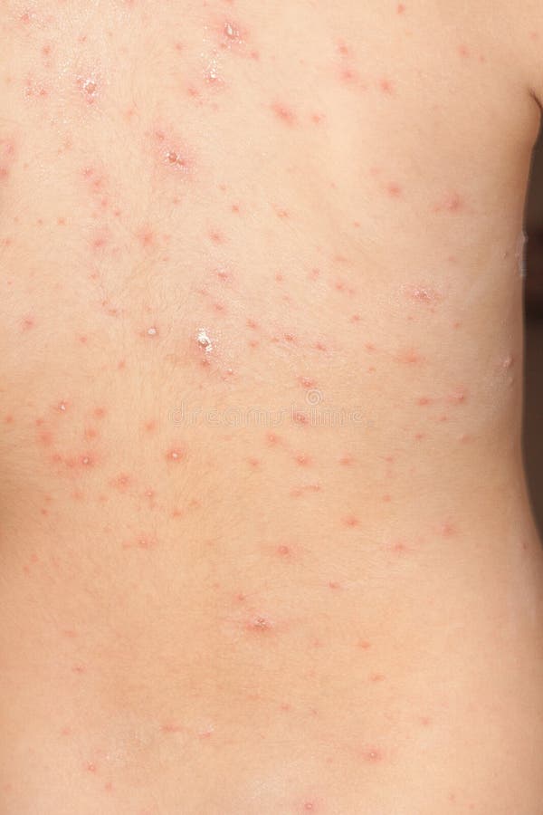 Smallpox stock photo. Image of illness, baby, chickenpox 51781100