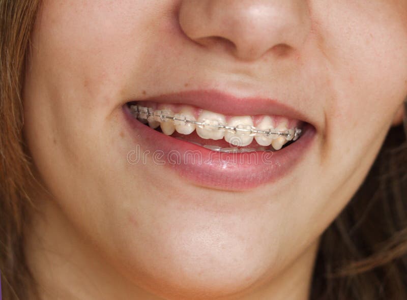 Pretty Smile with Braces stock image. Image of perfect 5886225