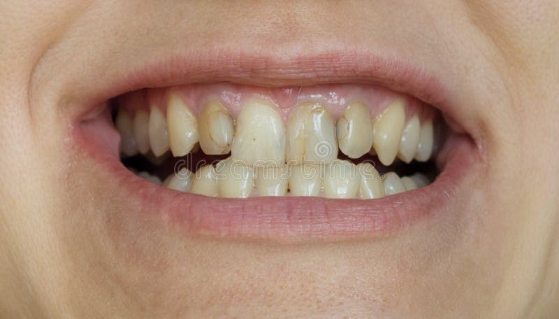 Smile med fula, krokgula tänder royaltyfri fotografi Smile med fula, krokgula tänder royaltyfri fotografi