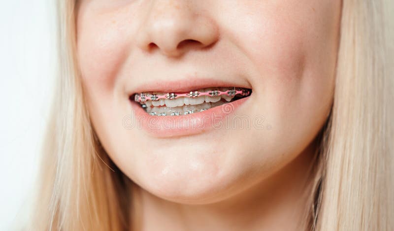 283 Braces Rubber Bands Stock Photos - Free & Royalty-Free Stock Photos  from Dreamstime