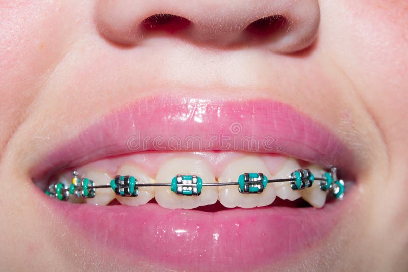 Smiling girl with braces stock image. Image of lips, smooth 75817973