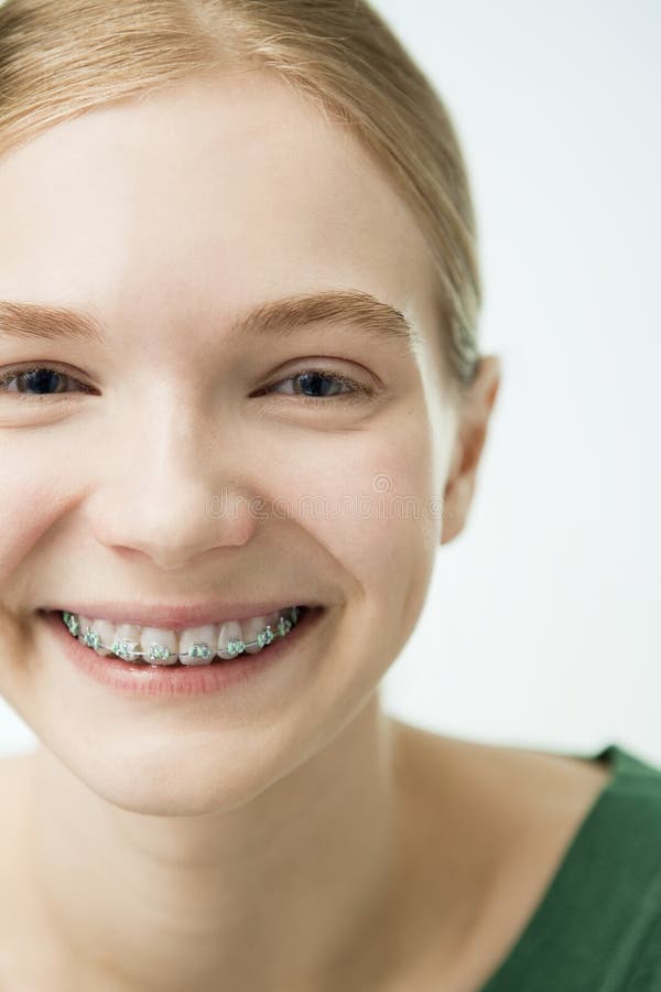 The Smiling Girl with Dental Braces. Stock Photo - Image of optimistic ...