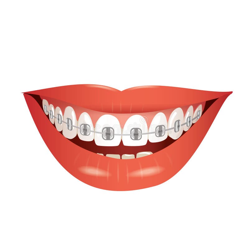 Braces Stock Illustrations 12,947 Braces Stock Illustrations, Vectors