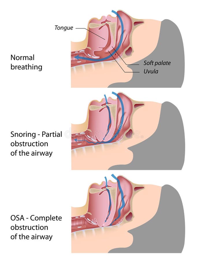 Anatomy of the airway in healthy subject compared to snoring and obstructive sleep apnea, eps10. Anatomy of the airway in healthy subject compared to snoring and obstructive sleep apnea, eps10