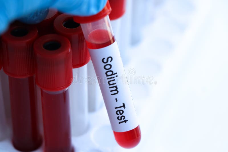 Sodium Test To Look for Abnormalities from Blood Stock Image Image of