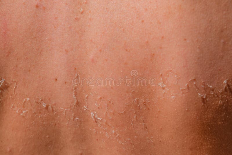 Solarizzazione sulla pelle della parte posteriore Lo sfaldamento, pelle pela Abbronzatura pericolosa