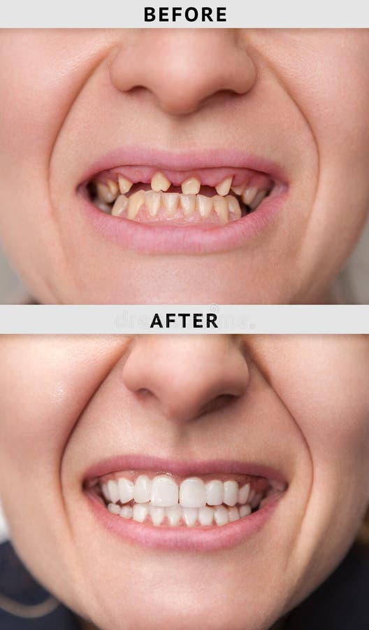 sonrisa femenina después y antes de dental foto de archivo libre de regalías sonrisa femenina después y antes de dental foto de archivo libre de regalías