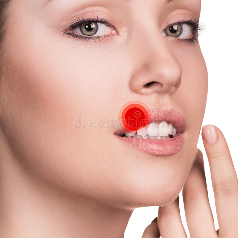 Sore on the female lips stock photo. Image of pimple 71299750