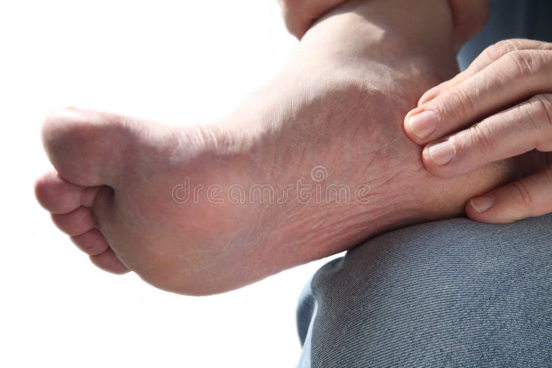Sore foot stock image. Image of debilitating, foot, pain 24493239