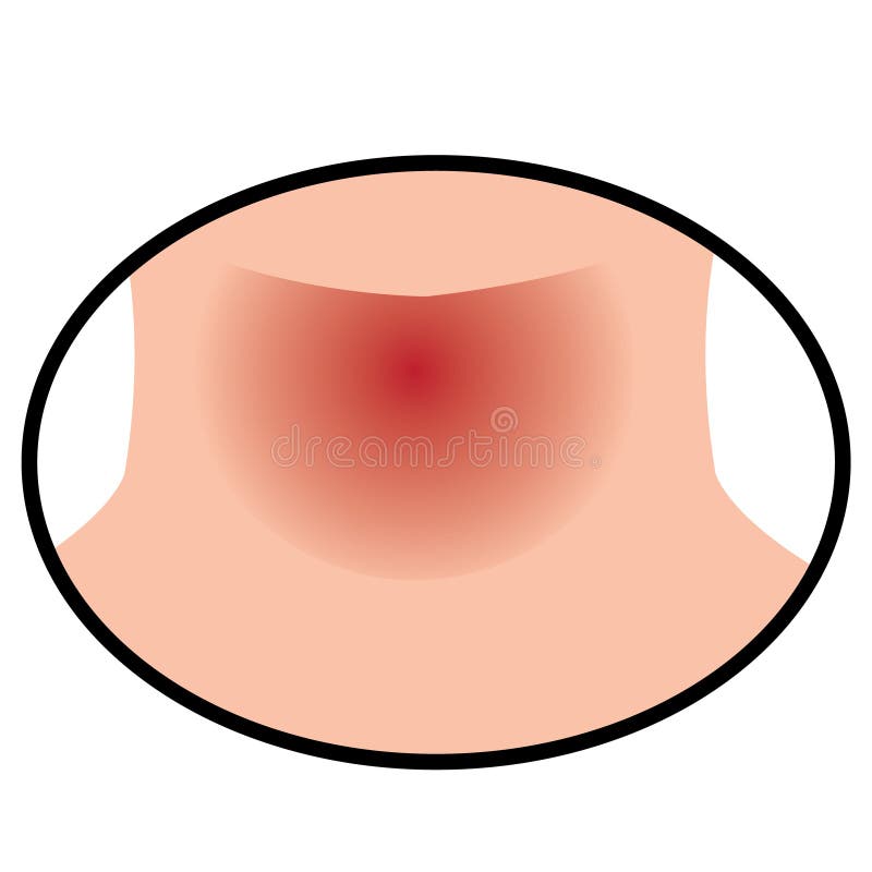 Sore throat because of flu insperatory infection vector illustration