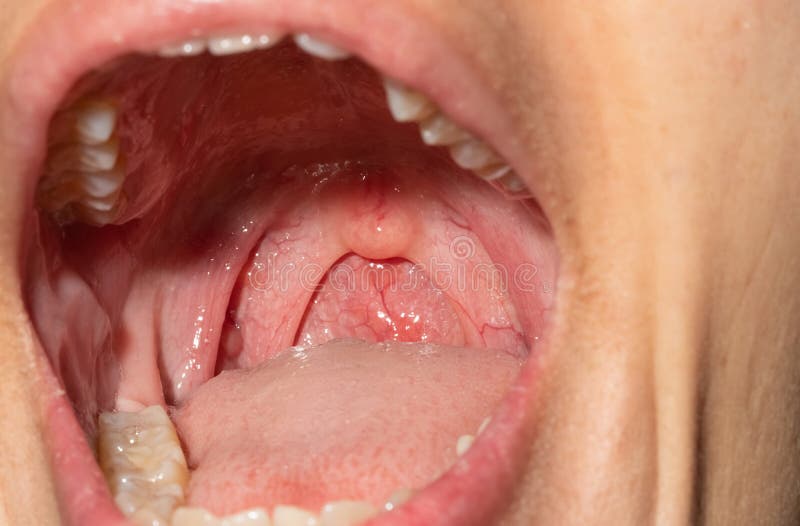 166 Uvula Photos - Free & Royalty-Free Stock Photos from Dreamstime 166 Uvula Photos - Free & Royalty-Free Stock Photos from Dreamstime