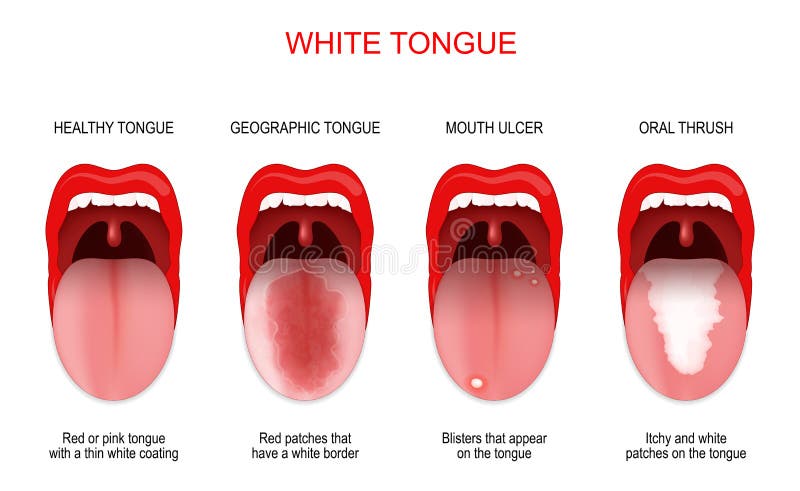 normal tongue coating