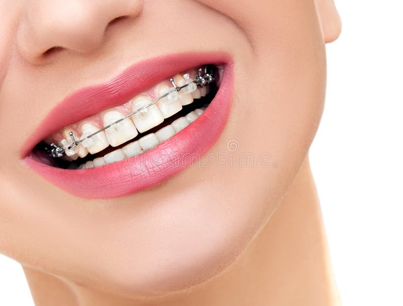 Sorriso della donna con i chiari ganci ortodontici sui denti fotografia stock Sorriso della donna con i chiari ganci ortodontici sui denti fotografia stock