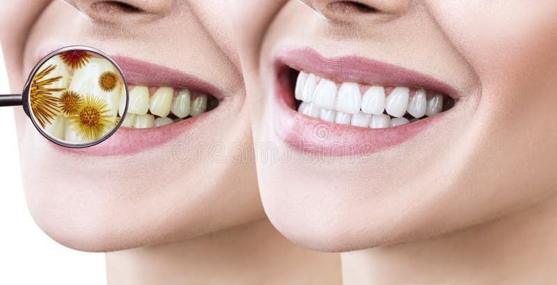 Sorriso fêmea antes e depois dos dentes que limpam dos germes imagens de stock royalty free Sorriso fêmea antes e depois dos dentes que limpam dos germes imagens de stock royalty free