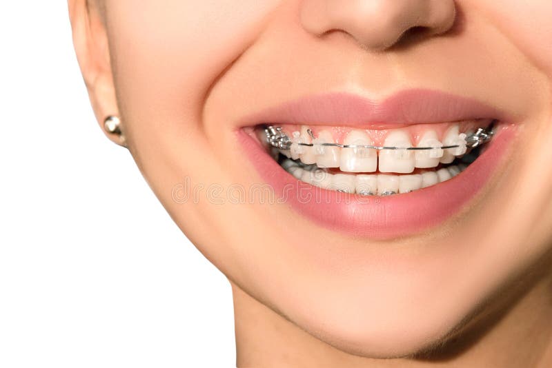 Sourire Femelle De Dents En Céramique De Bagues Dentaires Image stock -  Image du supports, occasionnel: 52572209