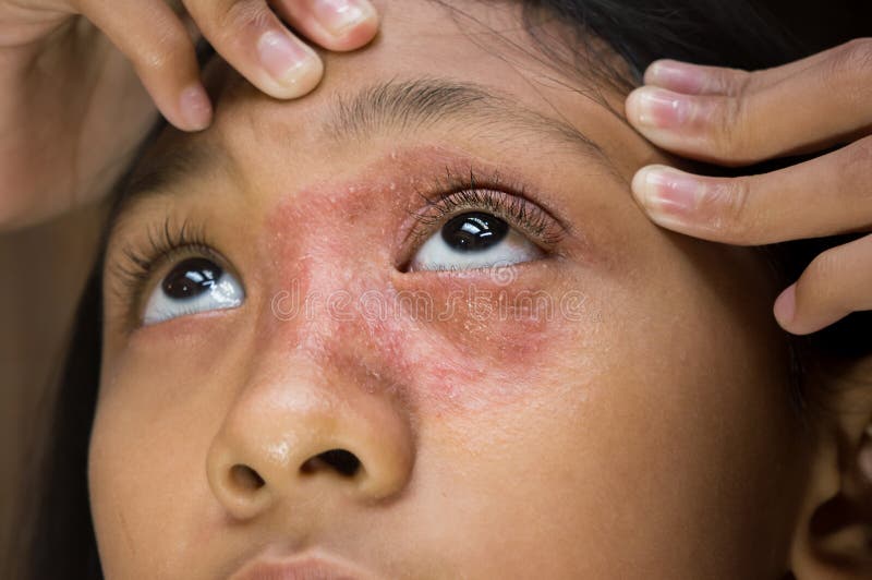 Southeast Asian ethnicity teenage girl with circular shape dry skin rash on her face around the eye and nose, Tinea corporis