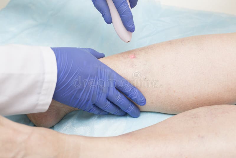 Specialist doctor conducts endovenous laser coagulation of the veins of the lower extremities. The concept of treatment for