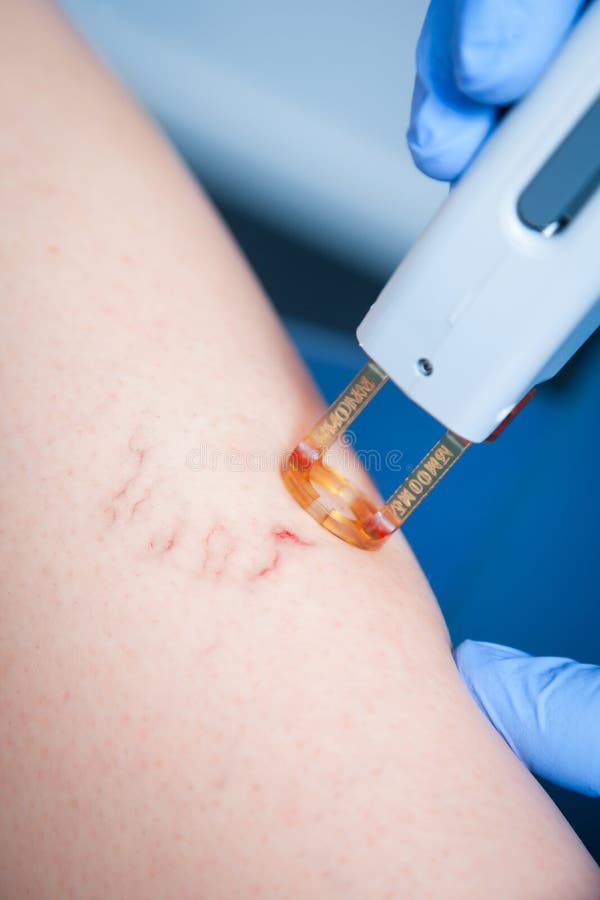 Spider vein medical laser