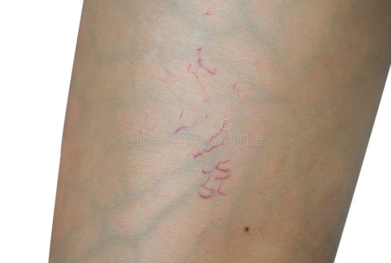 Spider veins on woman leg skin on white background. Concept before sclerotherapy or laser surgery to remove spider veins