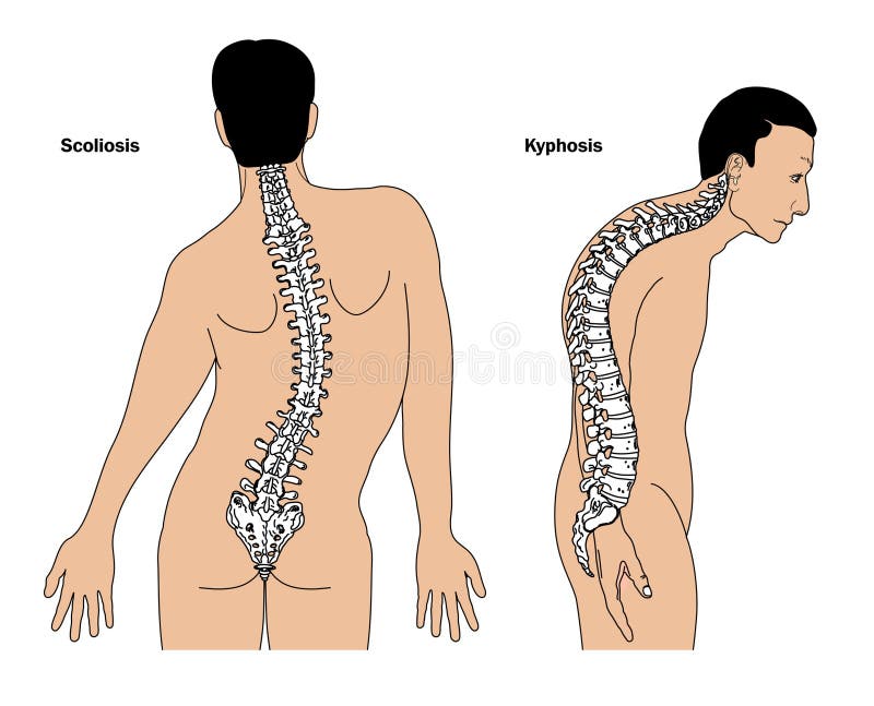 Deformità della colonna vertebrale, scoliosi e cifosi (gobbo)