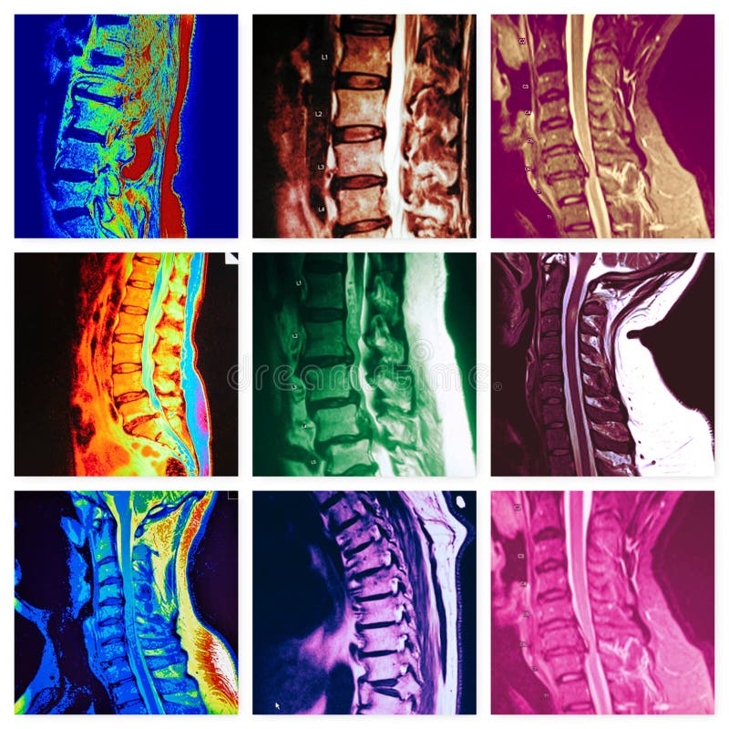 There are different areas of pathology in spinal vertebrae of human body from cervical to lumbar spine . With help of modern MRI exams its possible to see clear anatomical changes ,which can cause disease and pain. There are different areas of pathology in spinal vertebrae of human body from cervical to lumbar spine . With help of modern MRI exams its possible to see clear anatomical changes ,which can cause disease and pain.