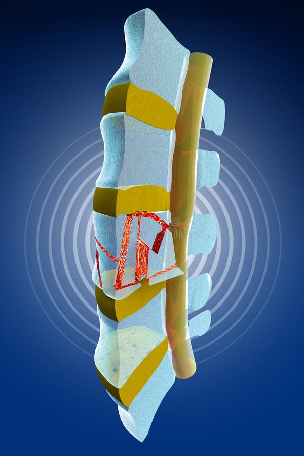 Spine, Marrow, Traumatic Fractures Vertebral Stock Illustration