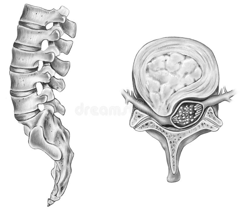 Spine - Ruptured Intervertebral Disc