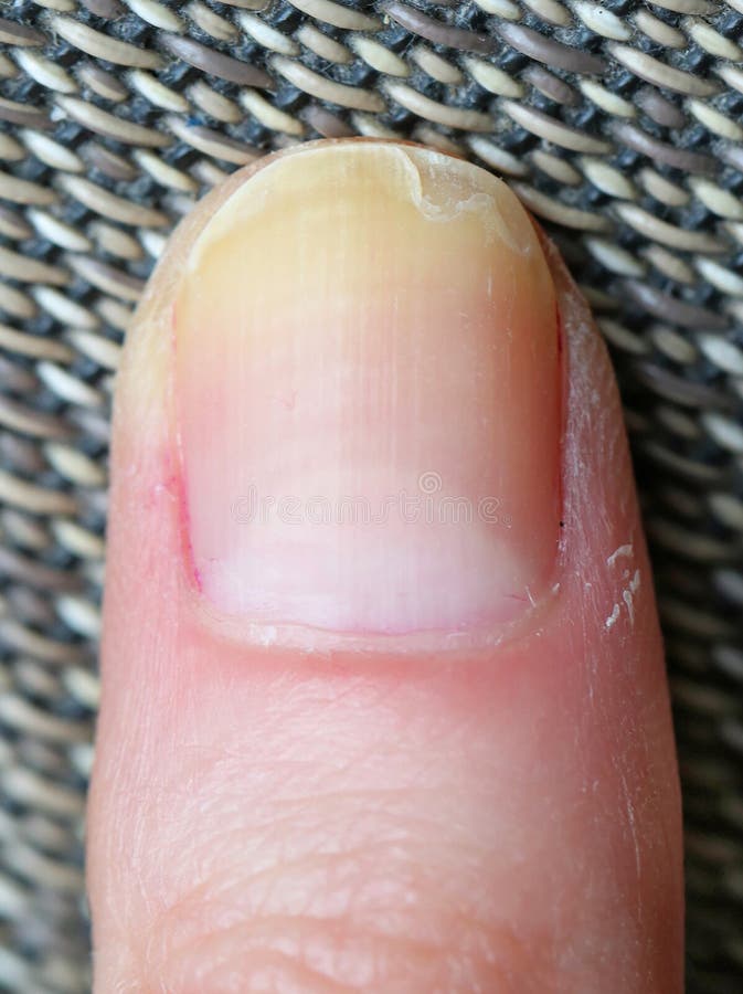 Nails with bloodstained discoloration | The BMJ
