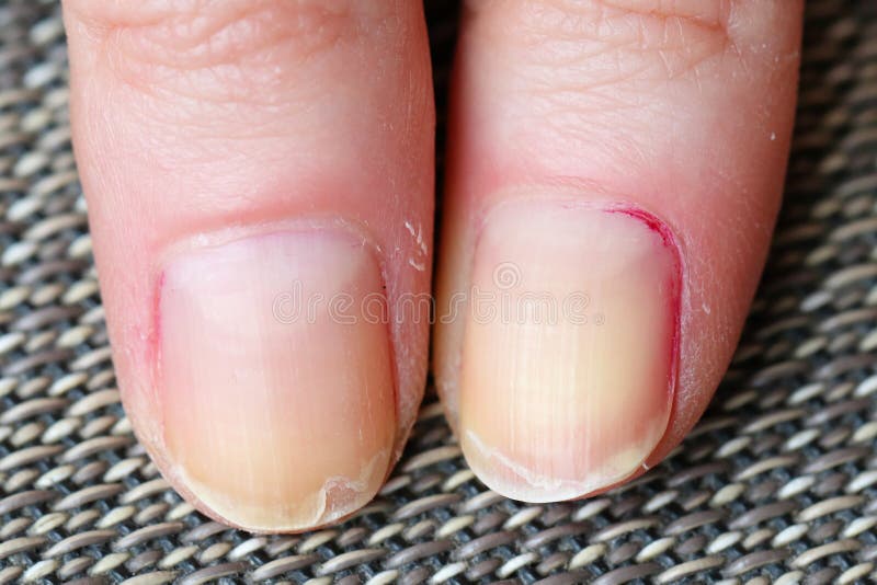 281 Brittle Nails Stock Photos - Free & Royalty-Free Stock Photos from Dreamstime 281 Brittle Nails Stock Photos - Free & Royalty-Free Stock Photos from Dreamstime