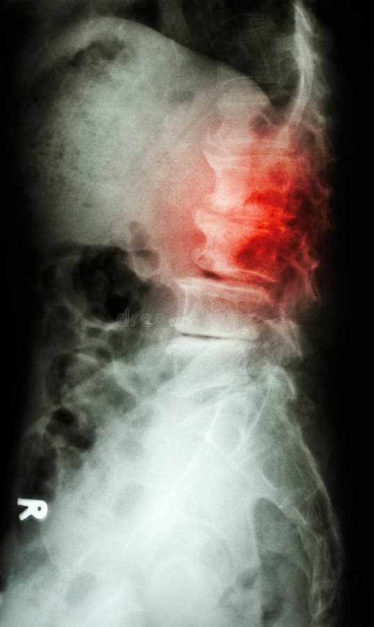 Spondylolisthesis film x-ray L-S spine lateral (lumbar-sacrum) of old aged patient royalty free stock photos Spondylolisthesis film x-ray L-S spine lateral (lumbar-sacrum) of old aged patient royalty free stock photos