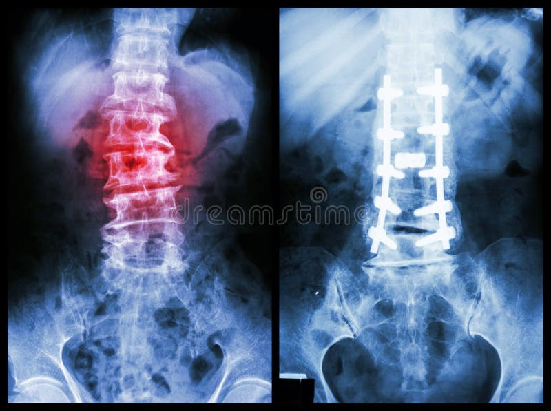 Spondylose stockfoto Spondylose stockfoto