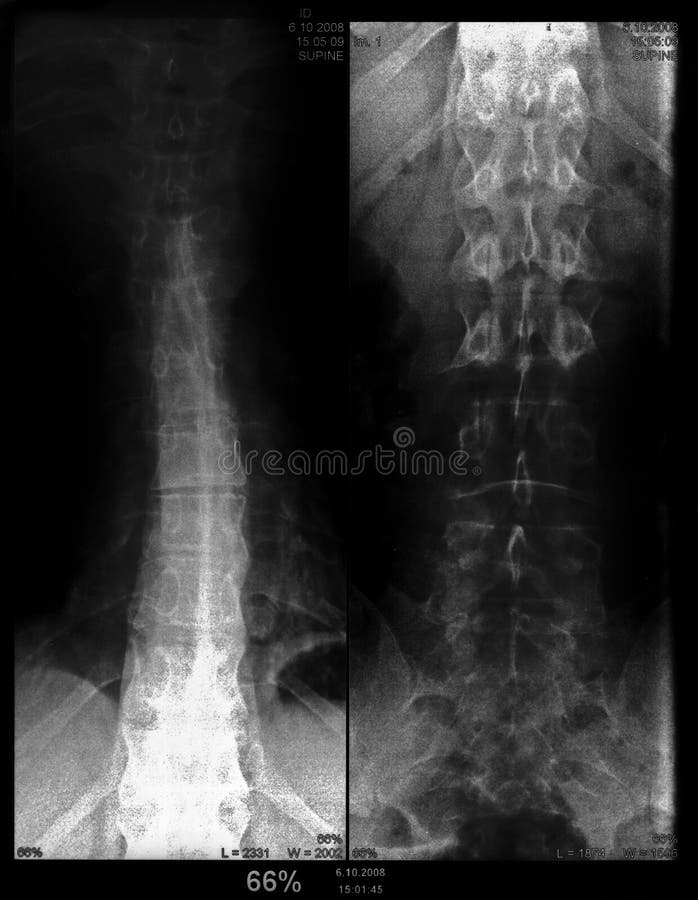 Spondylose image libre de droits Spondylose image libre de droits
