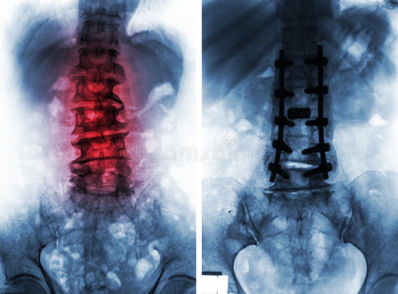 Spondylose Vor Und Nach Chirurgie Stockbild Bild von metall