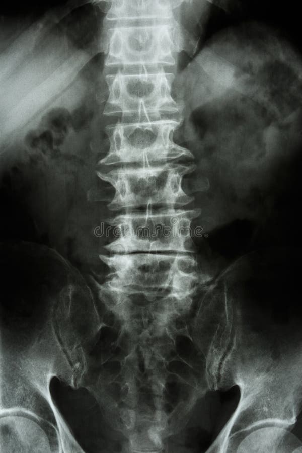 Spondylosis stock images Spondylosis stock images