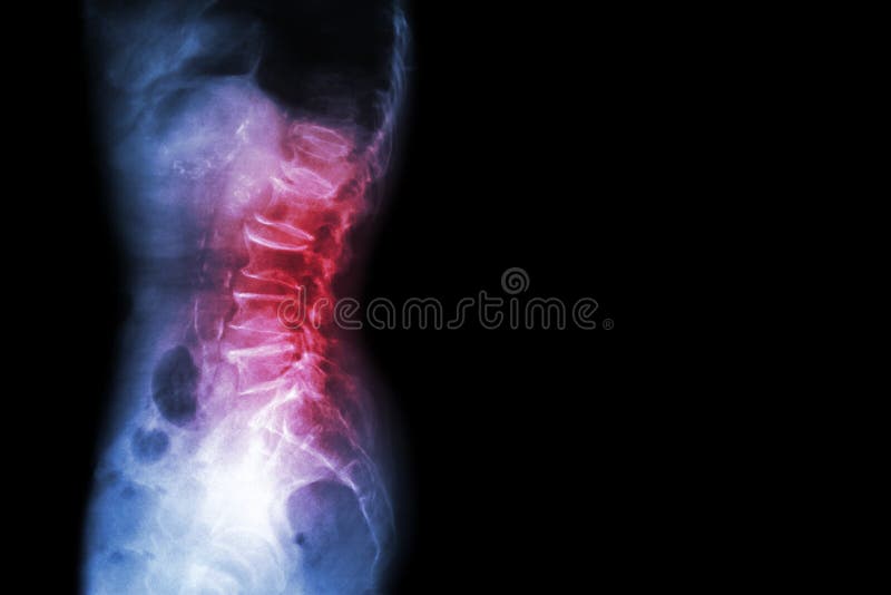 Spondylosis , Spondylolisthesis ( Film x-ray lumbo - sacral spine show spine collapse , decrease in disc space , bony spur format stock image Spondylosis , Spondylolisthesis ( Film x-ray lumbo - sacral spine show spine collapse , decrease in disc space , bony spur format stock image