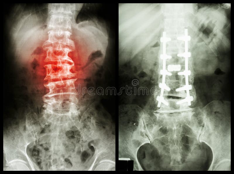 Spondylosis (Verlaten beeld) werd, Patiënt in werking gesteld en intern vast (Juist beeld)